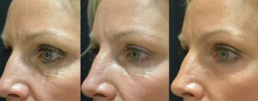sunshine coast facial treatments, skin treatment sunshine coast,skin rejuvenation treatment sunshine coast, skin tightening treatment sunshine coast, 