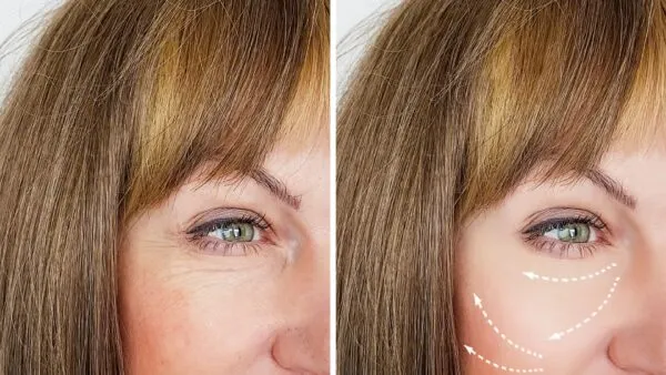 facial rejuvenation